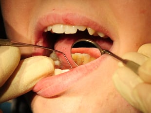 Just over quarter of Herefordshire adults see dentist in pandemic