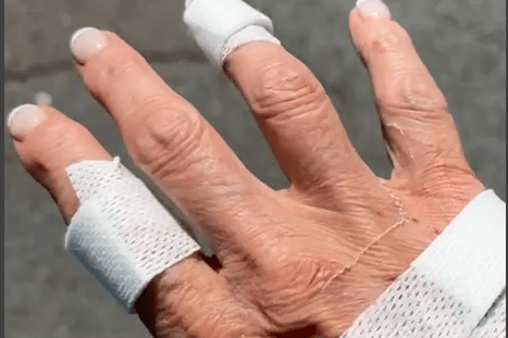 Helen's hand after the rescue